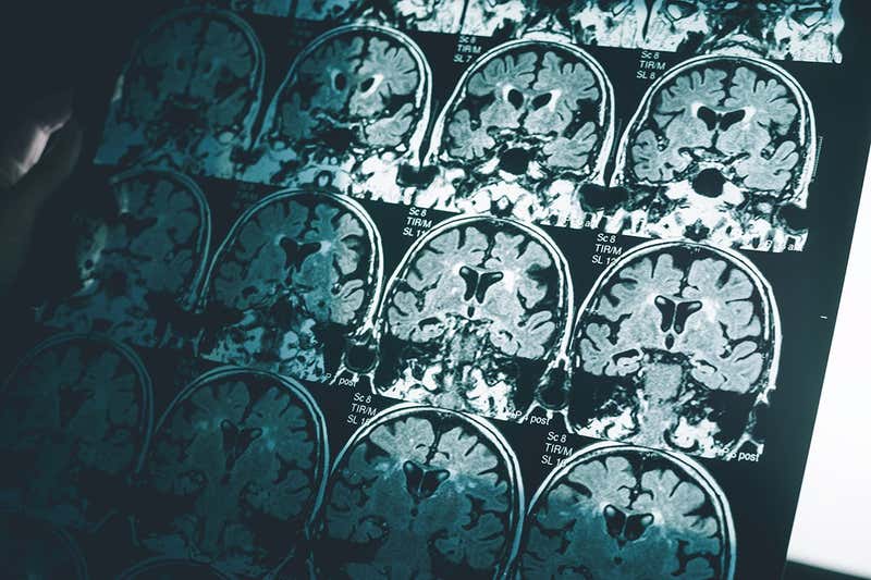 Acid produced by the brain could drive disease-related psychosis