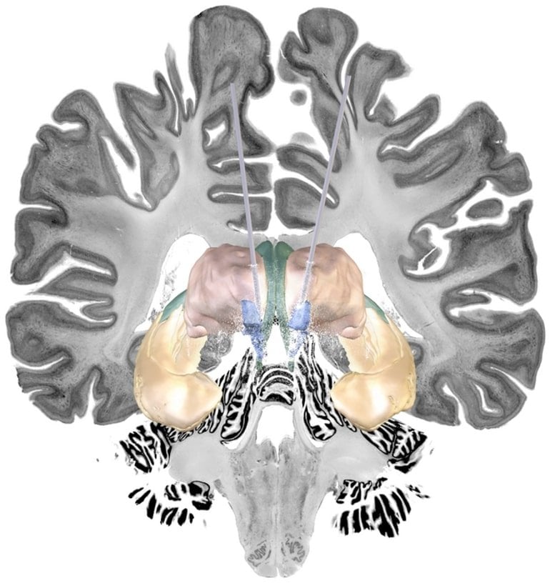 Brain Stimulation Could Help Treat Alzheimer’s Disease