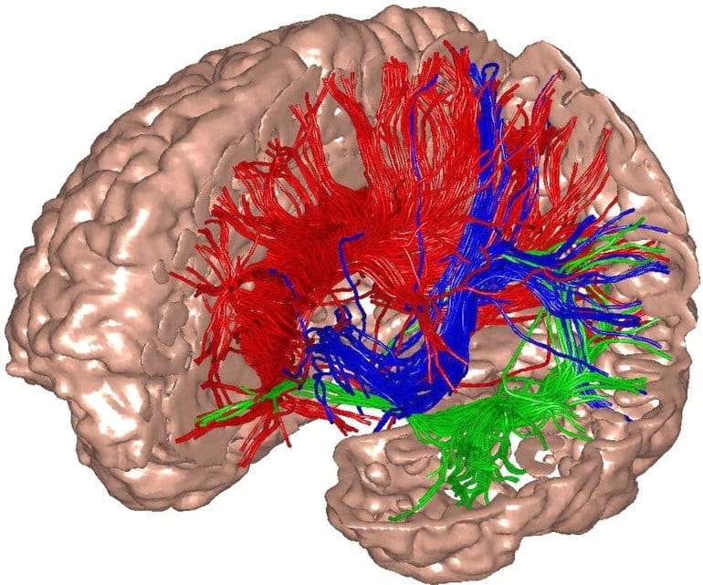 Ketamine Found to Increase Brain Noise