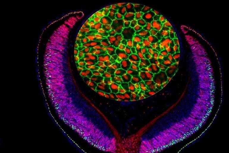 Combining Multiple Maps Reveals New Genetic Risk Factors for Age-Related Macular Degeneration