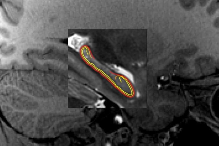 New Open-Source App for Precise Brain Mapping