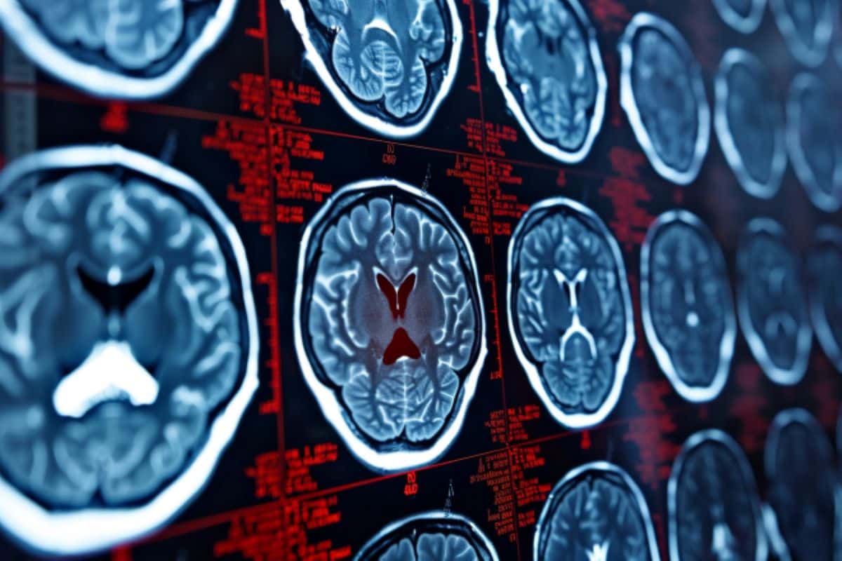 Vascular Risks Linked to Brain Health and Cognitive Decline