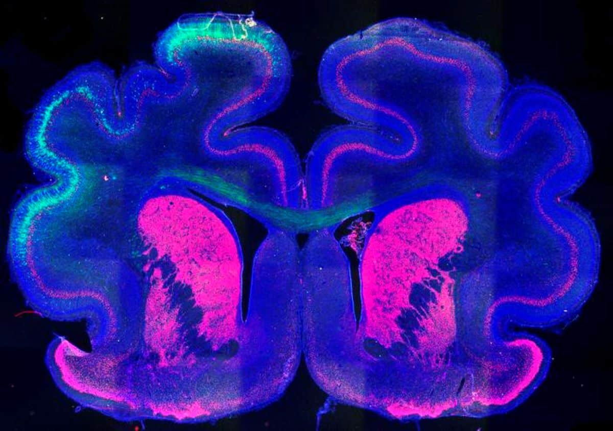 How Genes and Epigenetics Shape Brain Folding