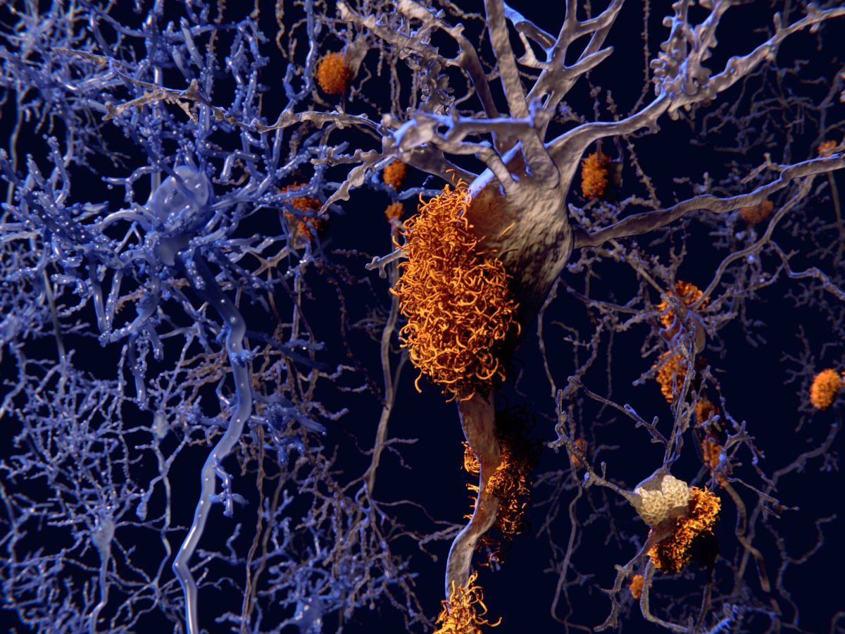 Alzheimer’s Worsened by Toxic Release From Brain’s Own Support Cells